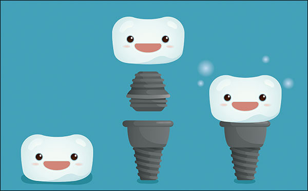 About Dental Implants | Minneapolis Dental 