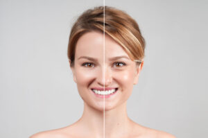 Juvederm