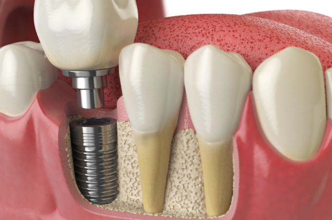 Dental Implants & Risks Associated with it