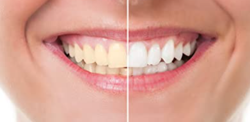 Teeth whitening treatment