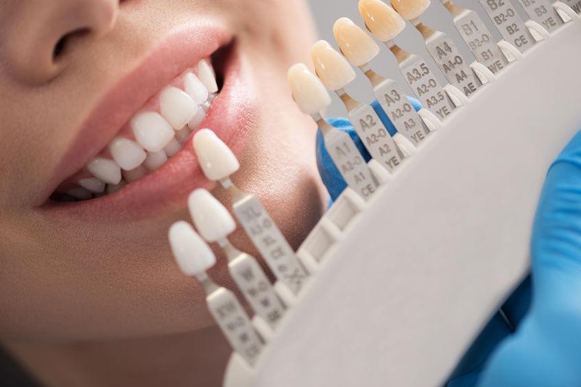 Dental Veneers
