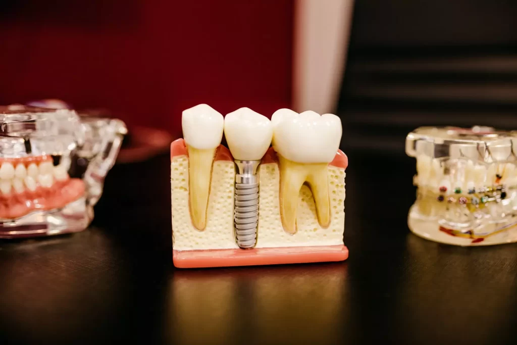 IMPLANT