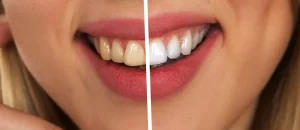 Benefits of Cosmetic Dentistry