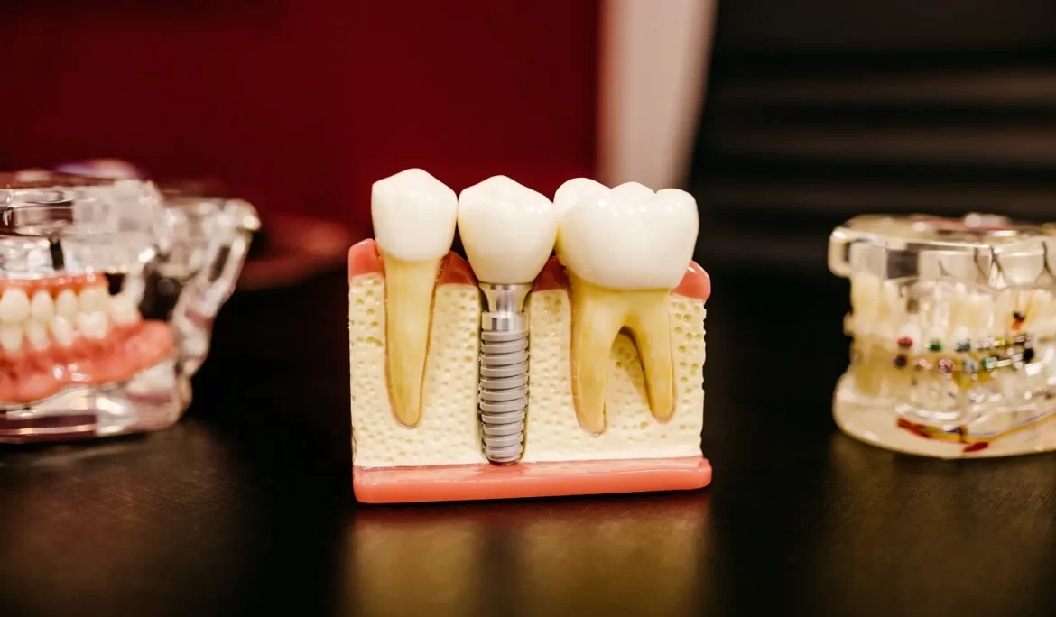 Single tooth implant
