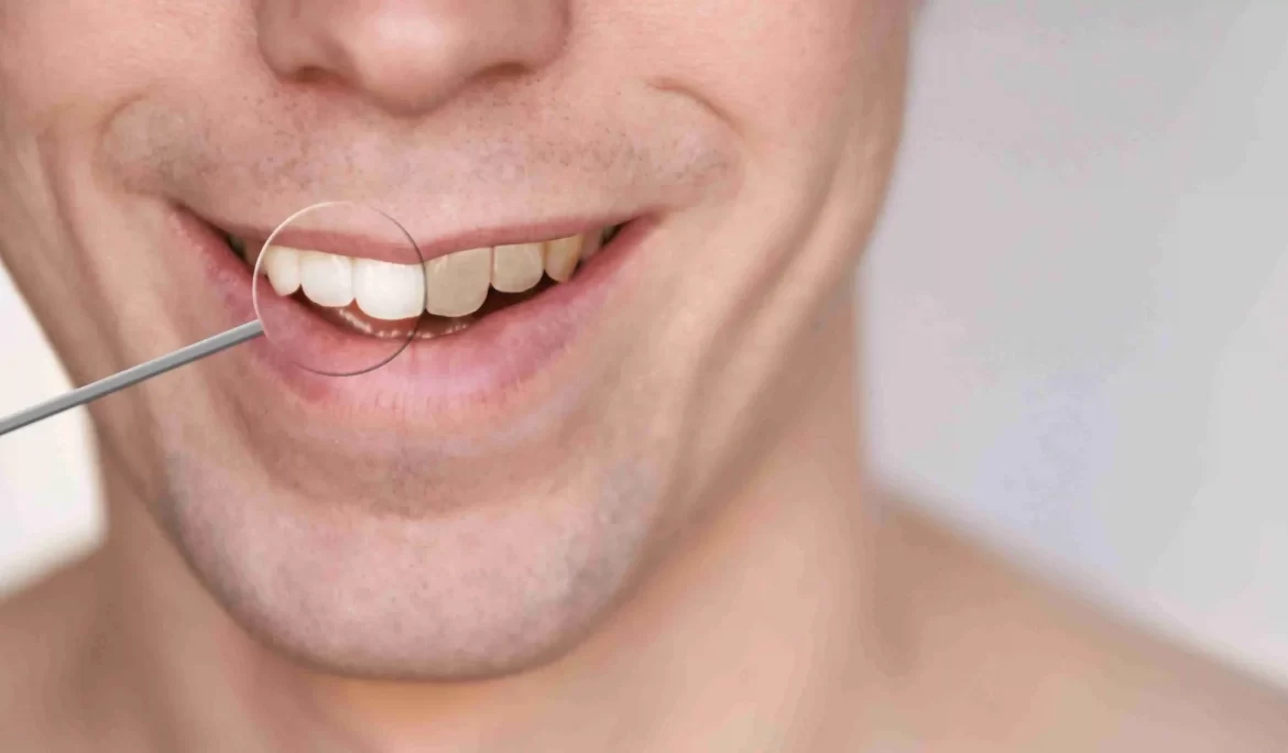 Teeth Whitening Before & After