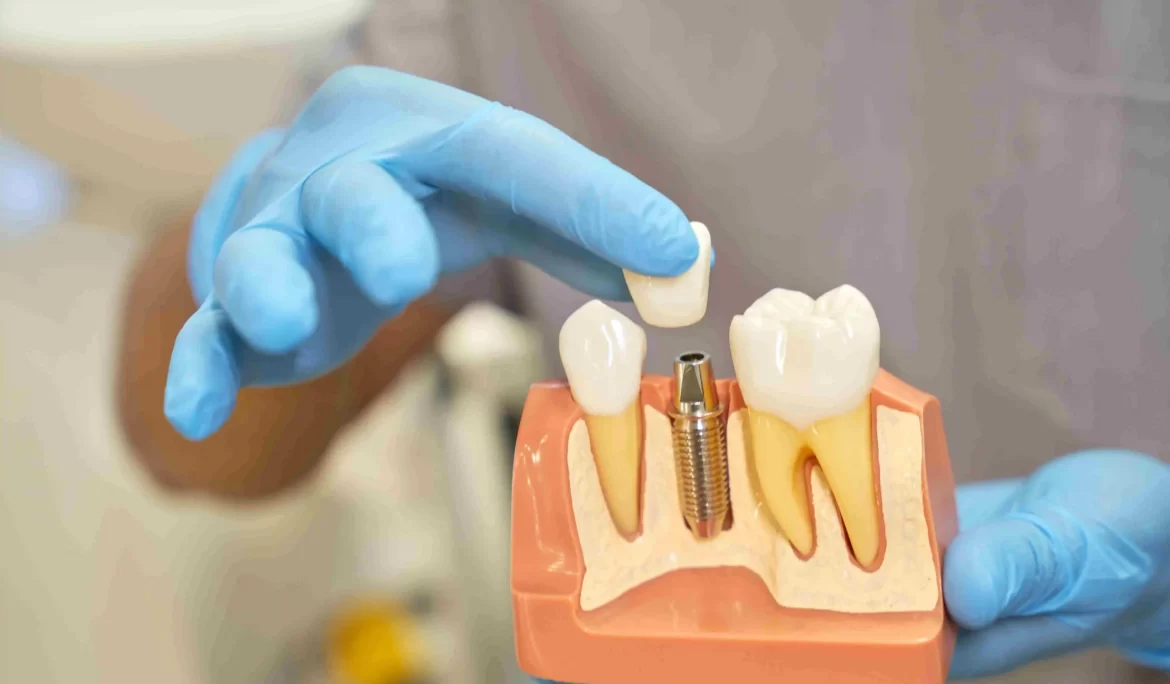 Dental Implants